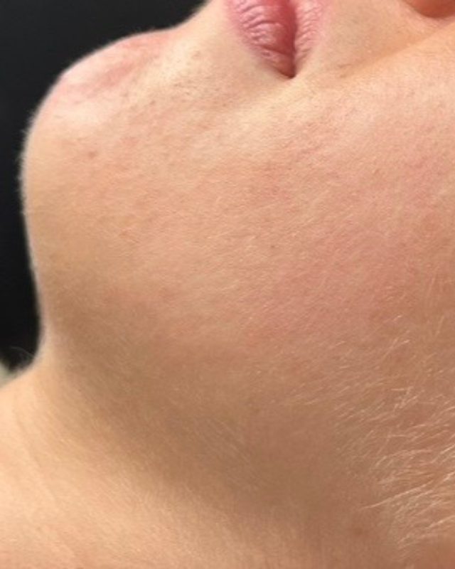 Clearer chin and jawline after acne treatment at Neo Elegance Skin Clinic, Derby