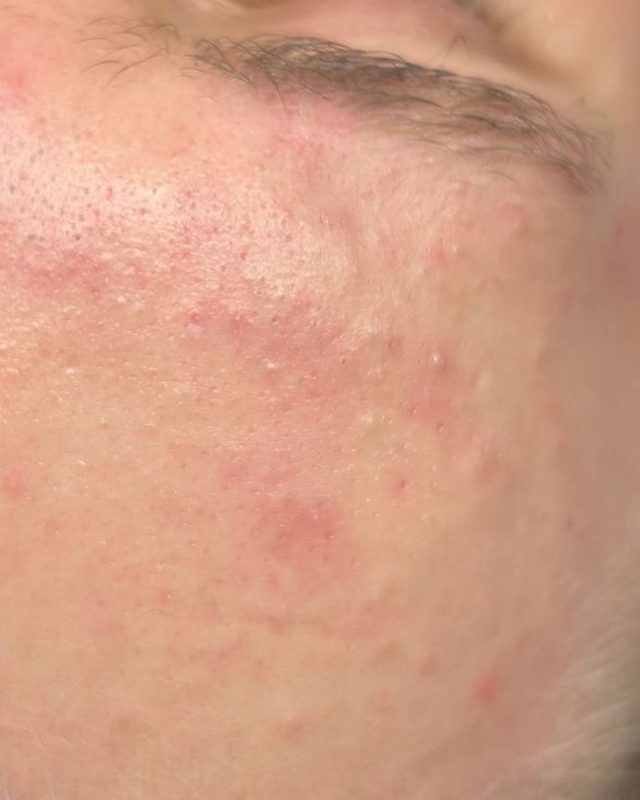 Clearer, smoother forehead and temple after acne treatment at Neo Elegance Skin Clinic, Derby