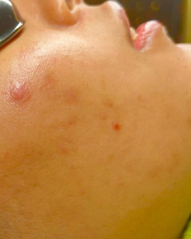 Calmer, clearer cheek after acne treatment at Neo Elegance Skin Clinic, Derby