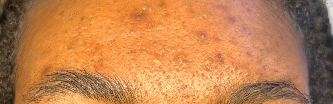 Calmer, clearer forehead after acne treatment at Neo Elegance Skin Clinic, Derby