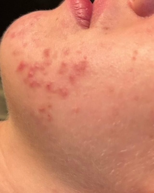 Active acne breakouts on the chin and jawline before treatment at Neo Elegance Skin Clinic, Derby