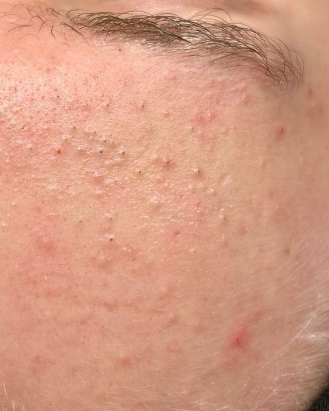 Congested skin with blackheads and closed comedones on the forehead and temple before treatment at Neo Elegance Skin Clinic, Derby