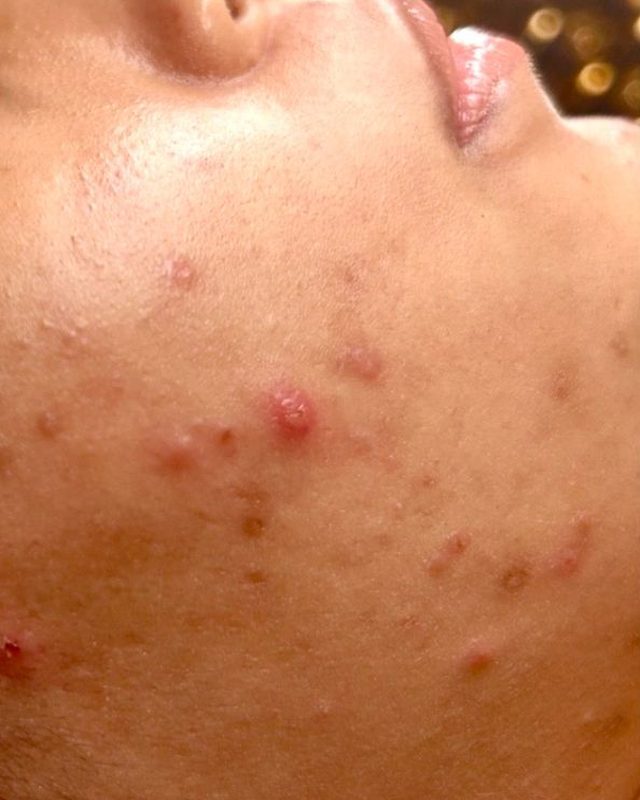 Inflamed acne breakouts and marks on the cheek before treatment at Neo Elegance Skin Clinic, Derby