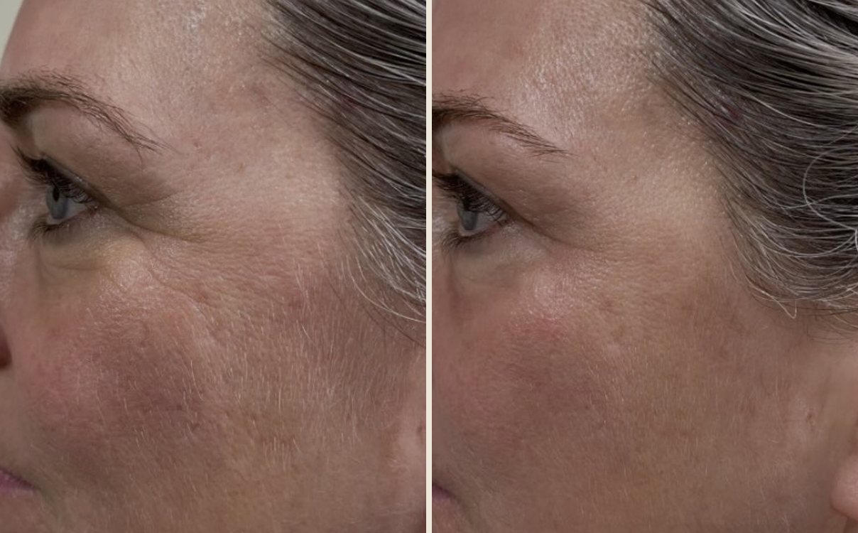 Before and after anti-ageing treatment at Neo Elegance Skin Clinic, Derby, showing softer lines around the eye and smoother cheek texture