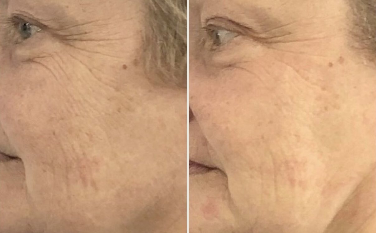 Before and after microneedling radiofrequency at Neo Elegance Skin Clinic, Derby, showing softer crow’s feet and smoother texture across the cheek