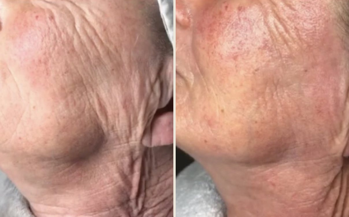 Before and after skin tightening at Neo Elegance Skin Clinic, Derby, showing firmer, smoother skin along the jaw and neck