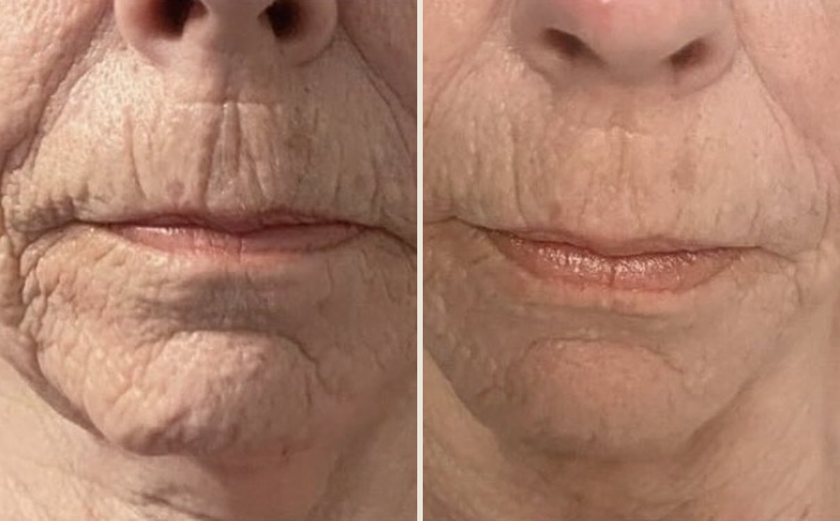 Before and after anti-ageing skin journey at Neo Elegance Skin Clinic, Derby, showing softer lines around the mouth and chin