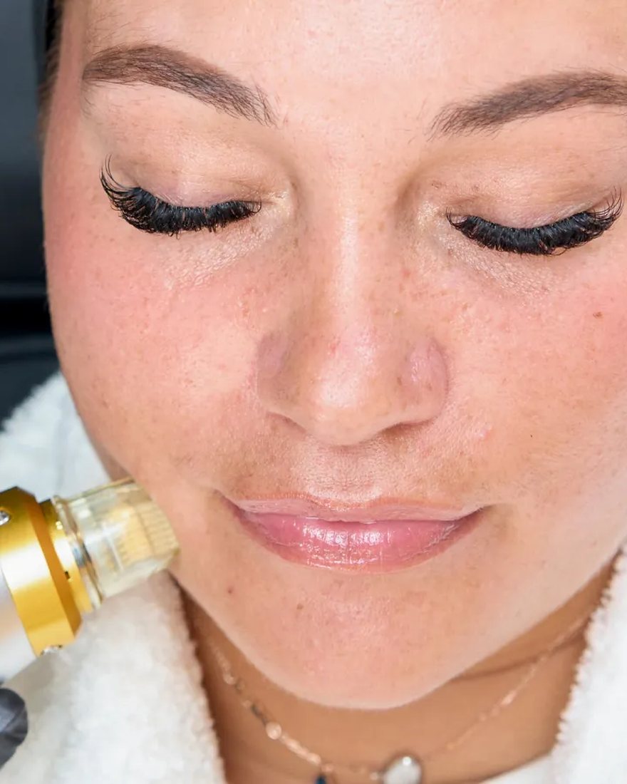 Radiofrequency microneedling anti-ageing treatment along the jawline at Neo Elegance Skin Clinic, Derby