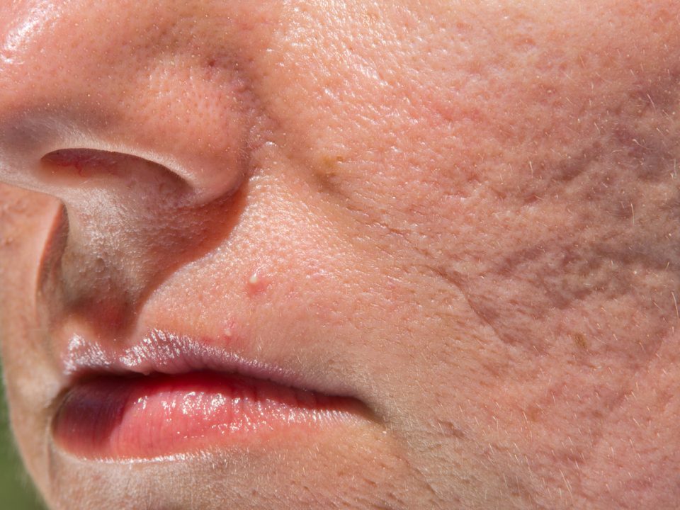 Close-up of indented acne scarring and uneven texture on the cheek