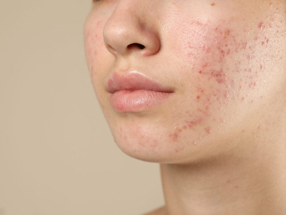 Close-up of active acne breakouts on the cheek and chin