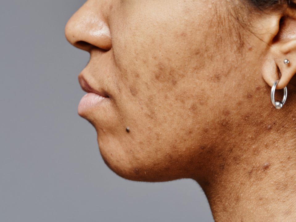 Close-up of dark marks and uneven pigmentation along the cheek and jaw