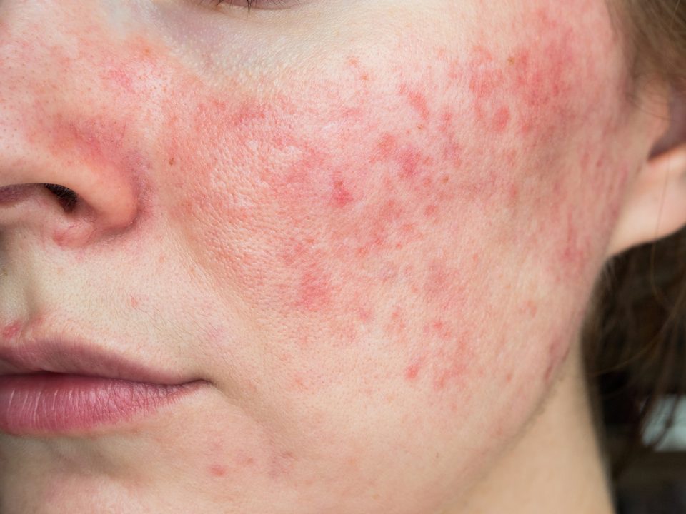 Close-up of rosacea redness across the cheek
