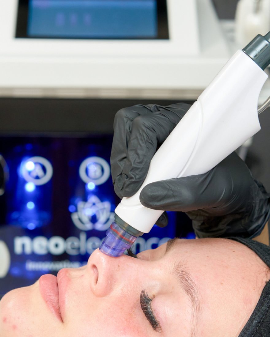 Hydrodermabrasion during a hydro facial at Neo Elegance Skin Clinic, Derby