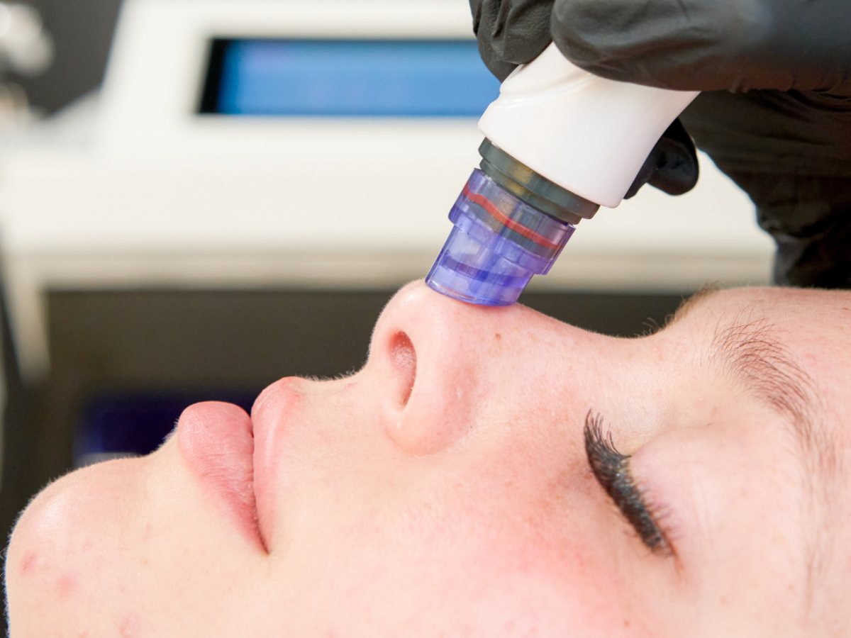 Close-up of the hydrodermabrasion tip clearing pores on the nose during a hydro facial in Derby
