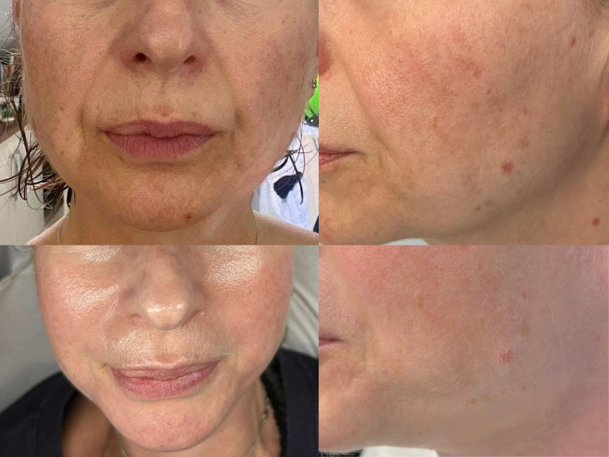 Before and after the MelanoPro Pigment Peel package at Neo Elegance Skin Clinic, Derby, showing reduced pigmentation on the cheek and jaw
