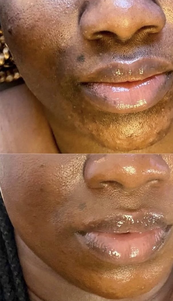 Before and after treatment for hyperpigmentation, melasma and acne on darker skin at Neo Elegance Skin Clinic, Derby, showing a clearer, more even tone around the mouth and chin