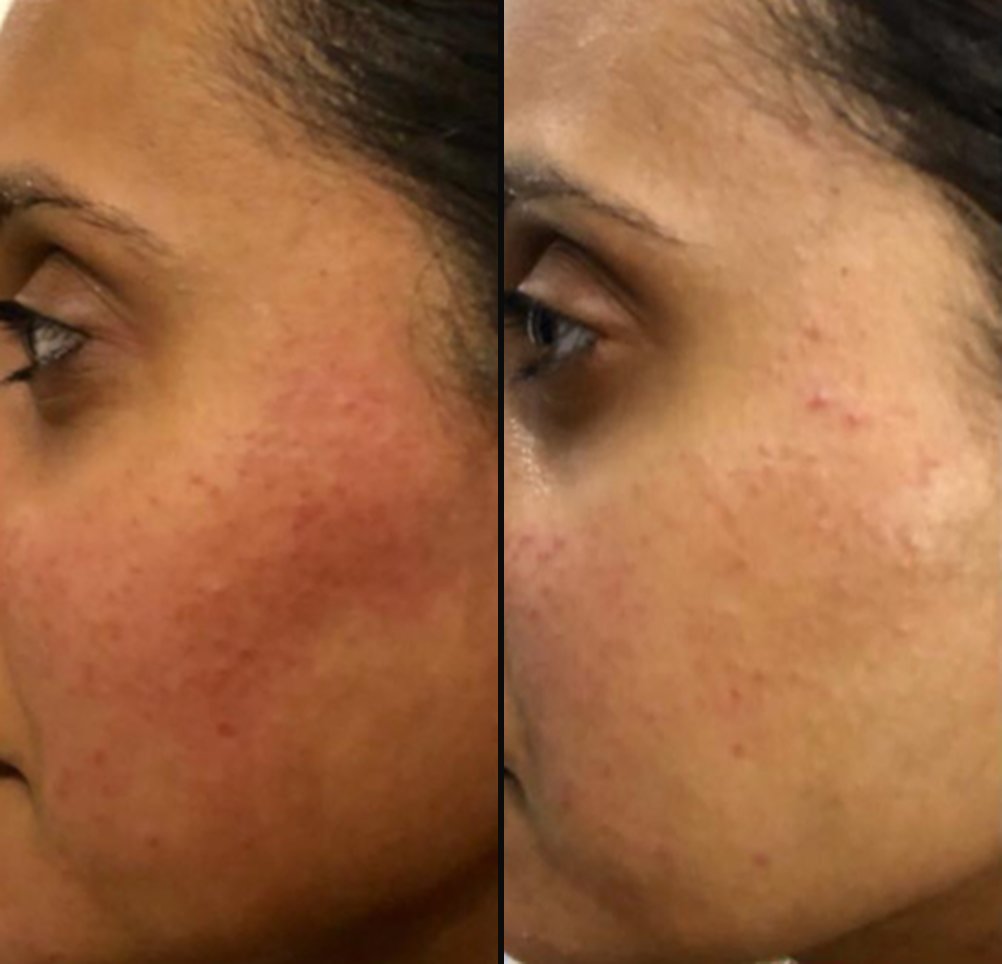 Before and after six sessions for redness and sensitive skin, showing a calmer, more even cheek