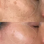 melanopro vs cosmelan
