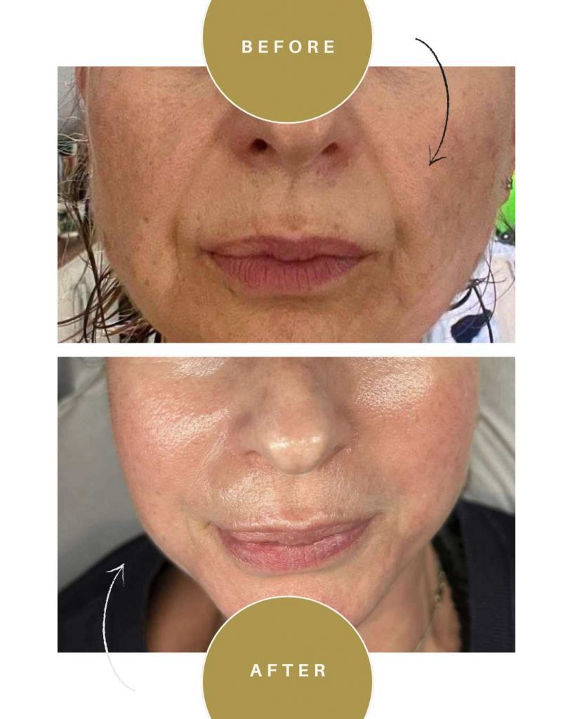 melanopro peel derby