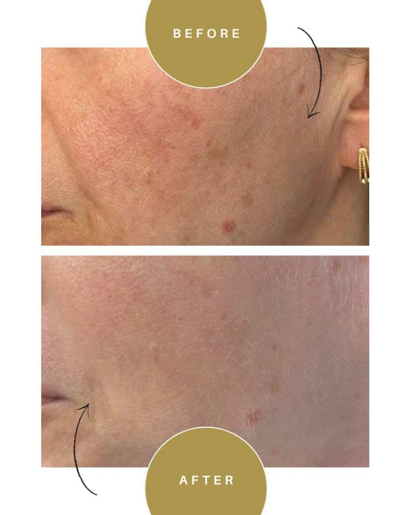 melanopro peel derby
